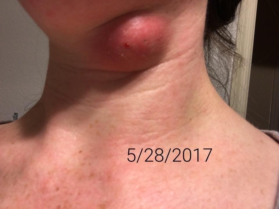 How I Healed My Sebaceous Cyst