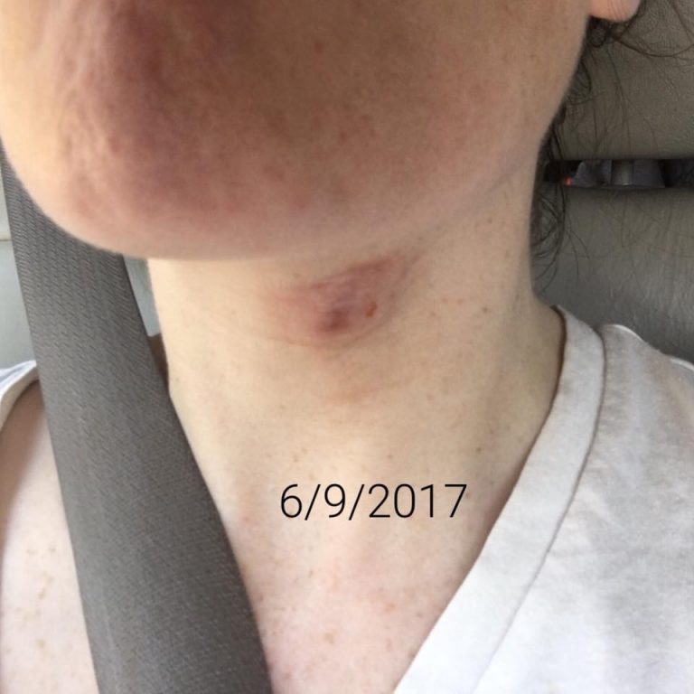 How I Healed My Sebaceous Cyst The Centsable Shoppin