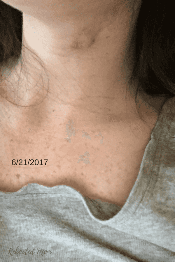 How I Healed my Sebaceous Cyst