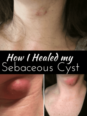 How I Healed my Sebaceous Cyst