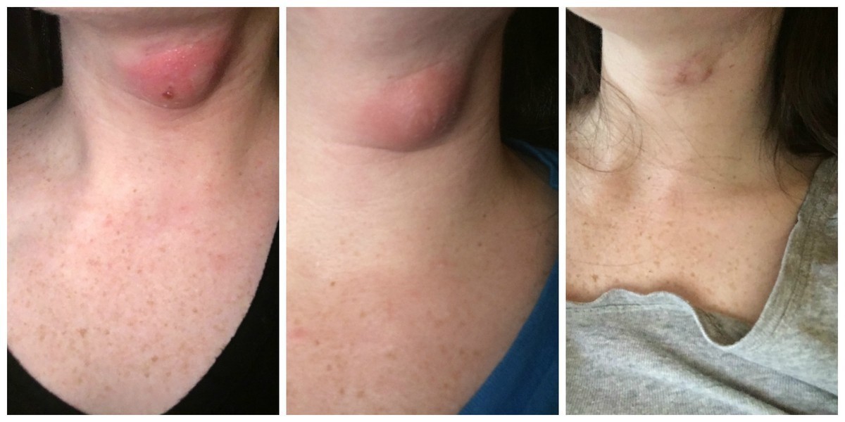 How I Healed My Sebaceous Cyst The Centsable Shoppin